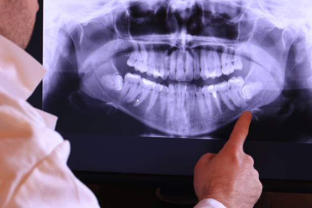 Best Emergency Wisdom Teeth Removal in Buchanan, VA